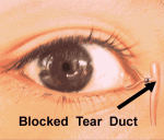 blocked_tear_duct